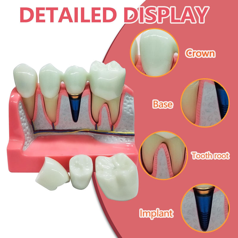 Dental Implant Model 4 Times Implant Teeth Model, Removable Dental Crown Bridge Model, Dental Implant Training Kit for Patient Education 4 teeth