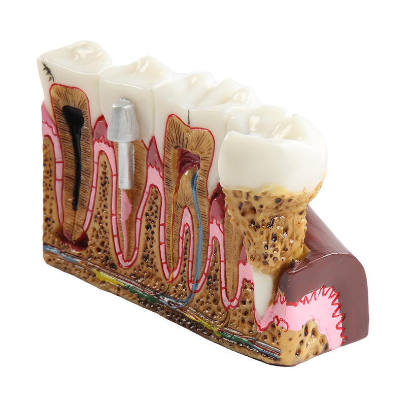 Dental Caries Tooth Anatomy Model Tooth Pathology Models | Caries Evolution Model, Comprehensive Structure Teaching, Oral Study