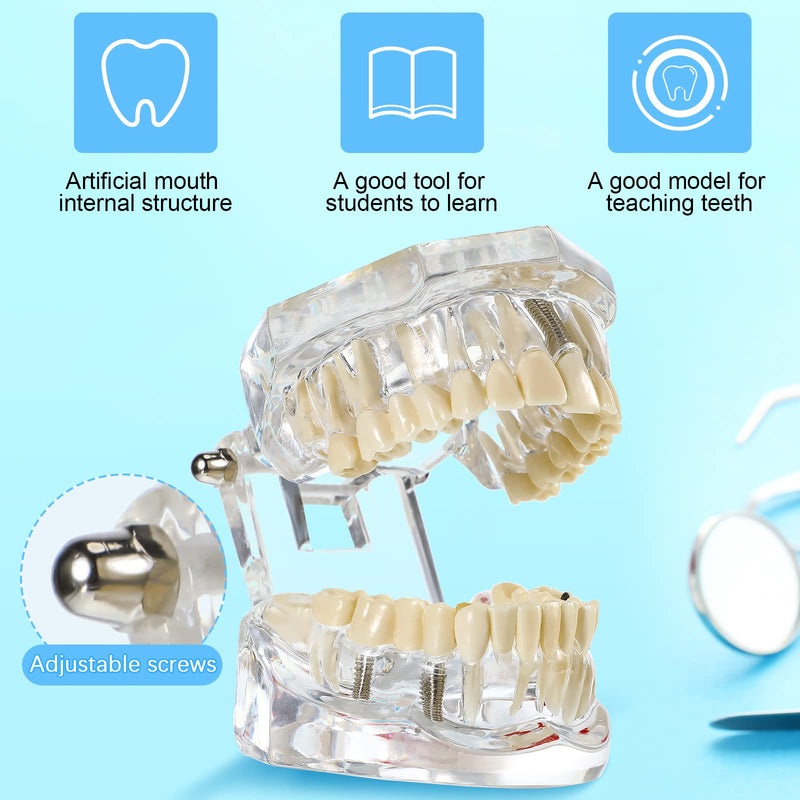 Outus Disease Teeth Model Dental Typodonts Implant Teeth Model with Removable Teeth Dentist Standard Tooth Pathological Demonstration for Christmas Education Dental Supplies (Transparent,1 Pcs) 1 Transparent