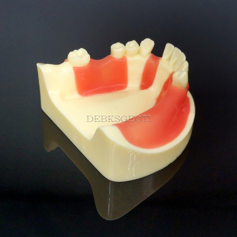 Dental Implant Typodont Practice Teeth Model Lower Jaw Overdenture Soft Gingiva Restoration Demo for Study Teach (M2004)