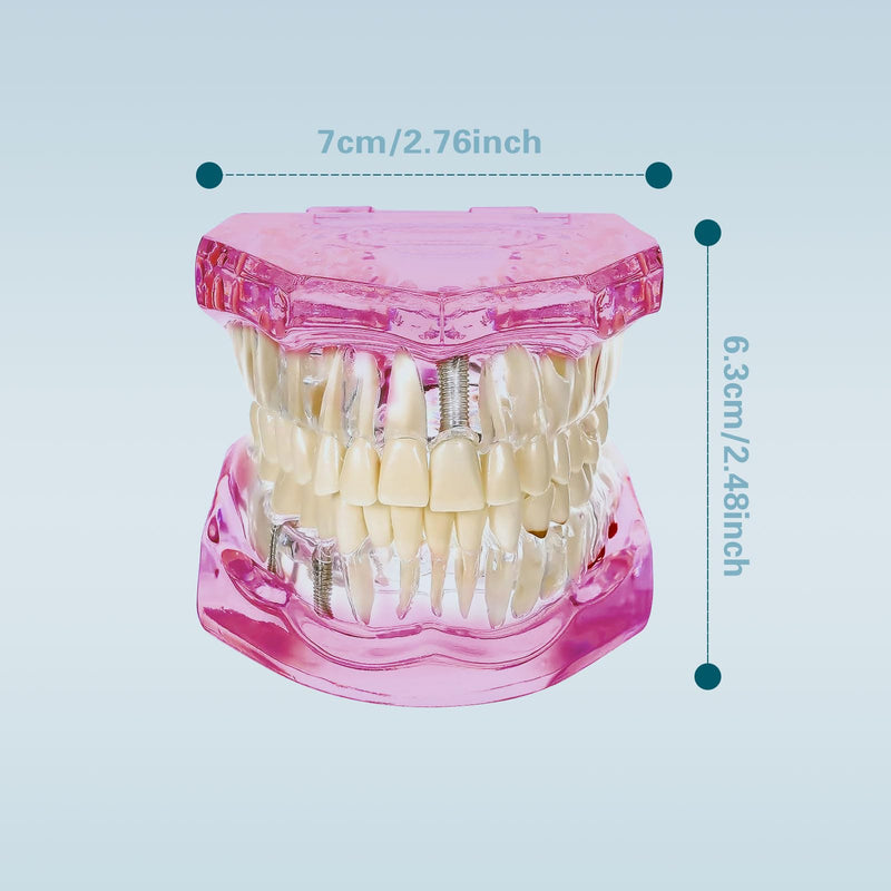 Transparent Disease Teeth Model with Dental Implant Bridge, Dental Teach Crown Bridge Removable Model, Tooth Model for Patient and Dental Student Education. (Red) Red