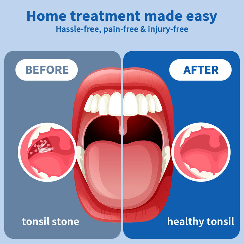 Upgraded Electronic Tonsil Stone Remover，Tonsil Stone Remover Vacuum，Tonsil Stones Removal kit，Tonsil Stone Extractor，7 in 1 Kit