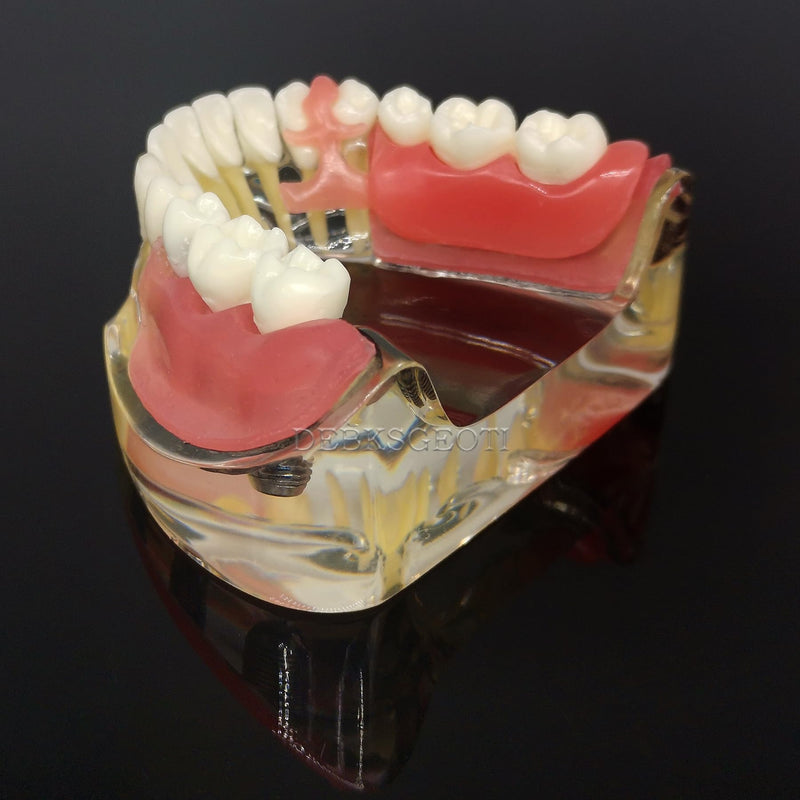 Dental Implant Typodont Restoration Teeth Model M6006 Overdenture 3 Implants Bridge Inferior Lower Treatment Demo for Study Teach