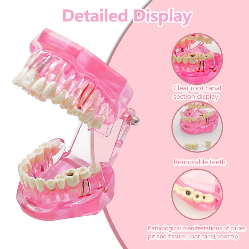 Transparent Disease Teeth Model with Dental Implant Bridge, Dental Teach Crown Bridge Removable Model, Tooth Model for Patient and Dental Student Education. (Red) Red
