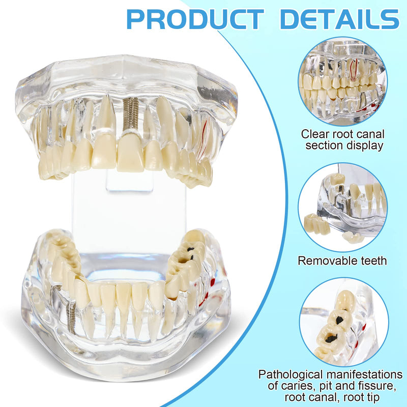 Outus Disease Teeth Model Dental Typodonts Implant Teeth Model with Removable Teeth Dentist Standard Tooth Pathological Demonstration for Christmas Education Dental Supplies (Transparent,1 Pcs) 1 Transparent