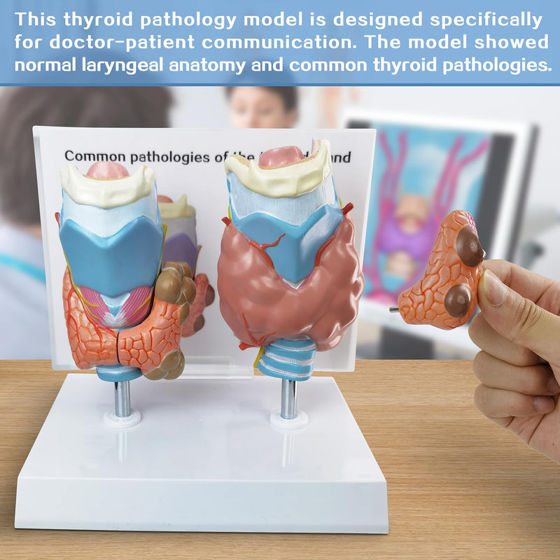 EVOTECH SCIENTIFIC Human Thyroid Pathology Anatomical Model - 4 Parts Life Size Medical Study Education Tool W/Stand and Manual for Demonstrating Goiter, Thyroid Cancer, and Graves’ Disease