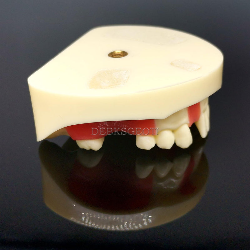 Dental Implant Typodont Practice Teeth Model Lower Jaw Overdenture Soft Gingiva Restoration Demo for Study Teach (M2004)