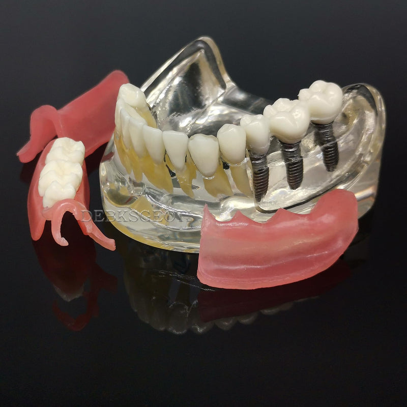Dental Implant Typodont Restoration Teeth Model M6006 Overdenture 3 Implants Bridge Inferior Lower Treatment Demo for Study Teach