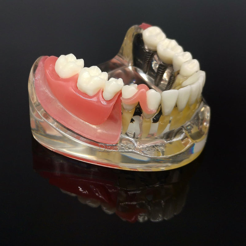 Dental Implant Typodont Restoration Teeth Model M6006 Overdenture 3 Implants Bridge Inferior Lower Treatment Demo for Study Teach