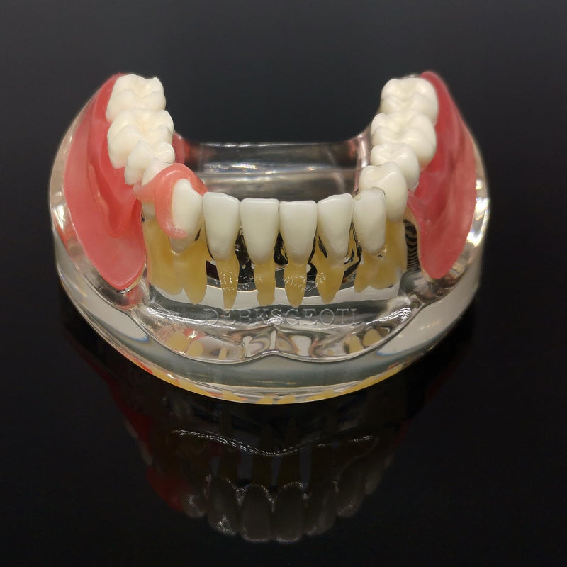Dental Implant Typodont Restoration Teeth Model M6006 Overdenture 3 Implants Bridge Inferior Lower Treatment Demo for Study Teach