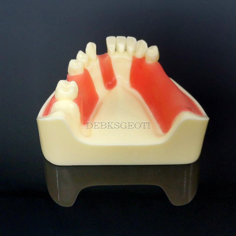 Dental Implant Typodont Practice Teeth Model Lower Jaw Overdenture Soft Gingiva Restoration Demo for Study Teach (M2004)