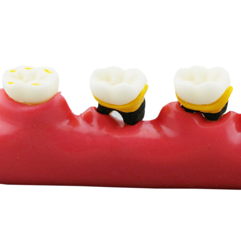 Dental Typodont Teeth Model M4010 Demonstrates The Progress of Periodontal Disease Category Pathology Dissect Teaching Study Demo