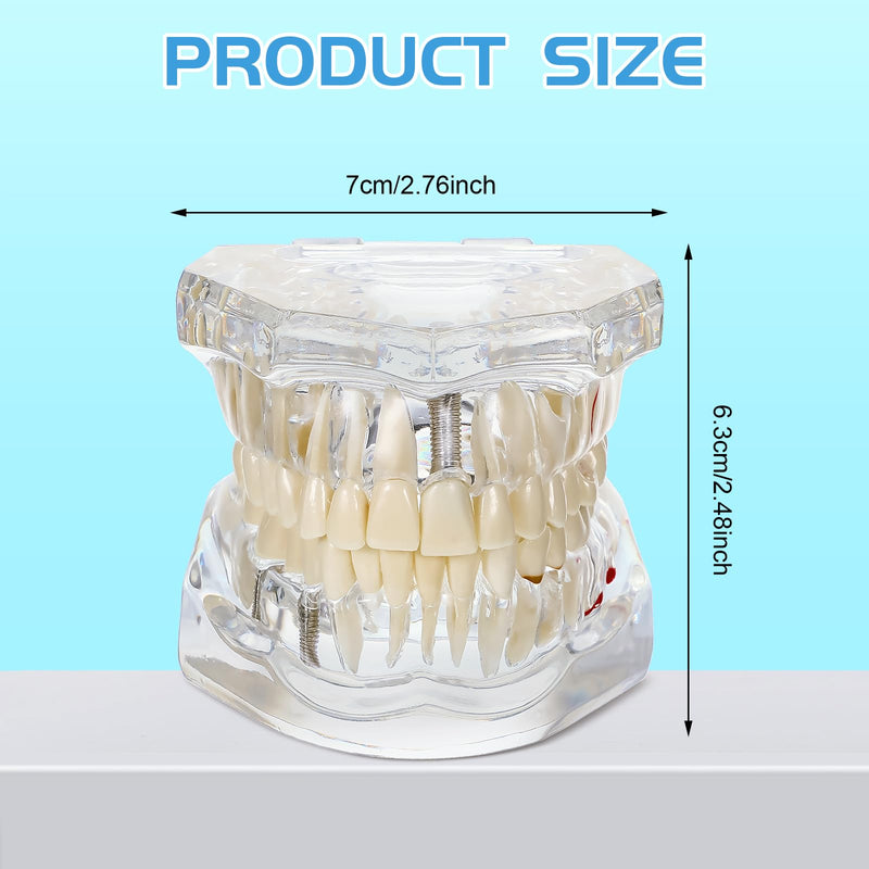 Outus Disease Teeth Model Dental Typodonts Implant Teeth Model with Removable Teeth Dentist Standard Tooth Pathological Demonstration for Christmas Education Dental Supplies (Transparent,1 Pcs) 1 Transparent