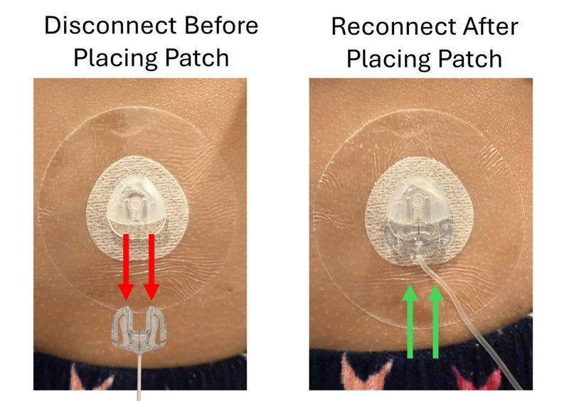 30pk Overpatches for AutoSoft XC, 90, 30, MiniMed Mio, Extended, Varisoft 13mm, Inset - Triangle Style Infusion Sets - Waterproof, Transparent, Breathable, Long Lasting