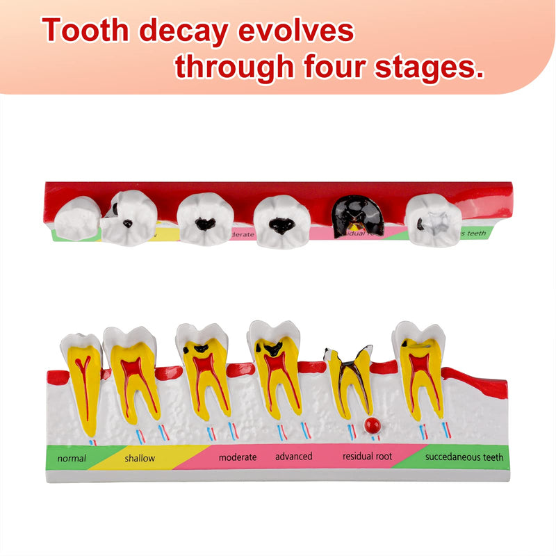 Dental Caries Developing Model, Dental Teeth Model for Dental Tooth Anatomy Study, Doctor-Patient and Oral Care Education Developing Decay Model