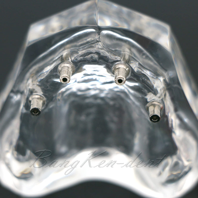 Dental Implant Typodont Restoration Teeth Model M6001 Clear Overdenture 4 Implants Superior Upper Demo for Study Teach