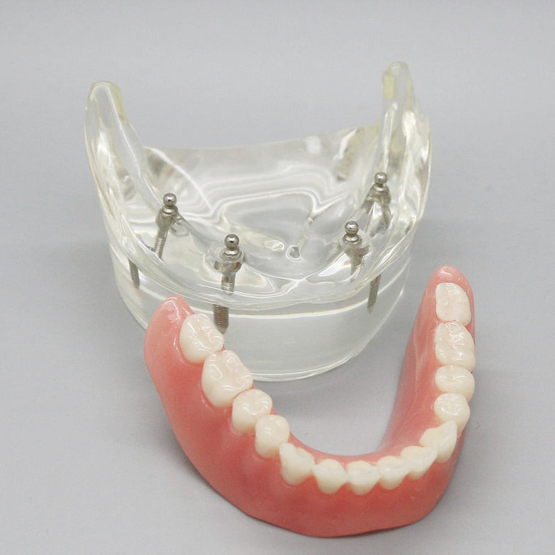 Dental Model Overdenture Inferior 4 Implants Demo for Teaching and Studying