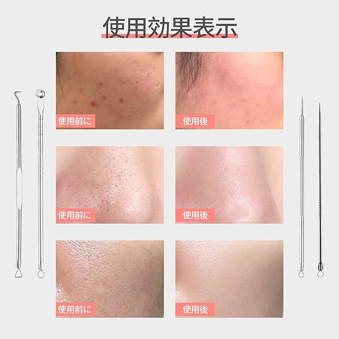 nalaina Square Stopper Remover, Square Plug, Tweezers (Set of 5) Acne Needle Set, Acne Pusher, Square Plug Pusher, Pore Care Kit, Strawberry Nose, Comedo Pusher, Acne Remover, Blackhead Removal, Storage Case, Stainless Steel, Portable, For Men and Women - NewNest Australia
