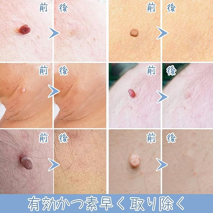 Iki Removal, Gintake Remover Tool, 0.1 - 0.4 inches (2 - 9 mm), Remove by Yourself, 66 Piece Band Set, 3 in 1 Kit, Face, Neck, Head, Armpits, Body, Unisex, Japanese Version - NewNest Australia