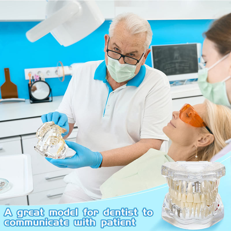 Outus Disease Teeth Model Dental Typodonts Implant Teeth Model with Removable Teeth Dentist Standard Tooth Pathological Demonstration for Christmas Education Dental Supplies (Transparent,1 Pcs) 1 Transparent
