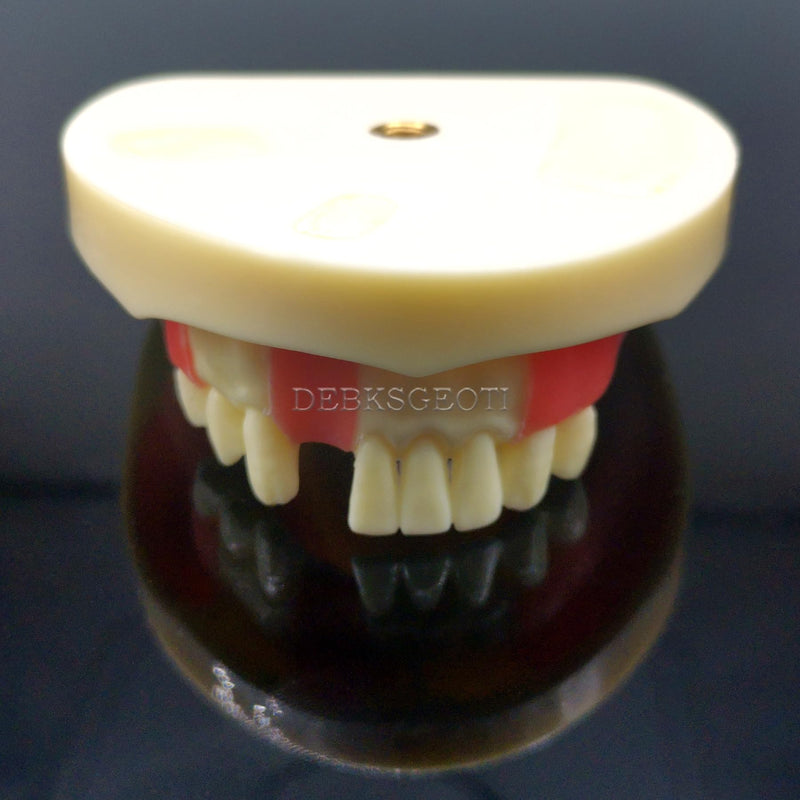 Dental Implant Typodont Practice Teeth Model Lower Jaw Overdenture Soft Gingiva Restoration Demo for Study Teach (M2004)
