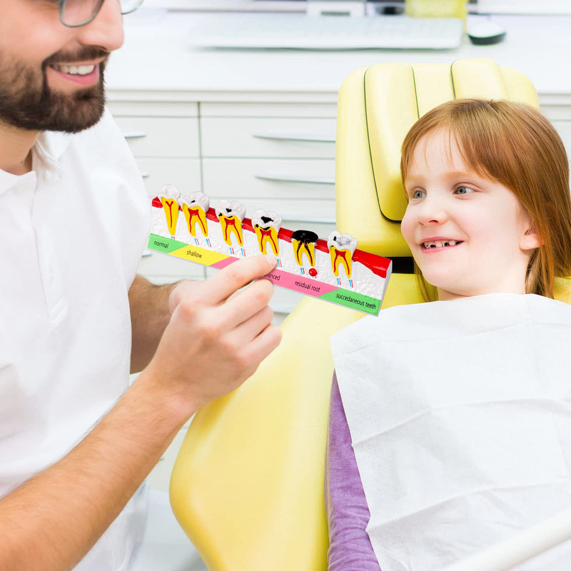 Dental Caries Developing Model, Dental Teeth Model for Dental Tooth Anatomy Study, Doctor-Patient and Oral Care Education Developing Decay Model