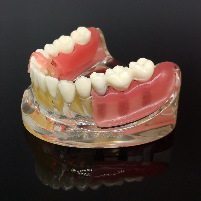 Dental Implant Typodont Restoration Teeth Model M6006 Overdenture 3 Implants Bridge Inferior Lower Treatment Demo for Study Teach
