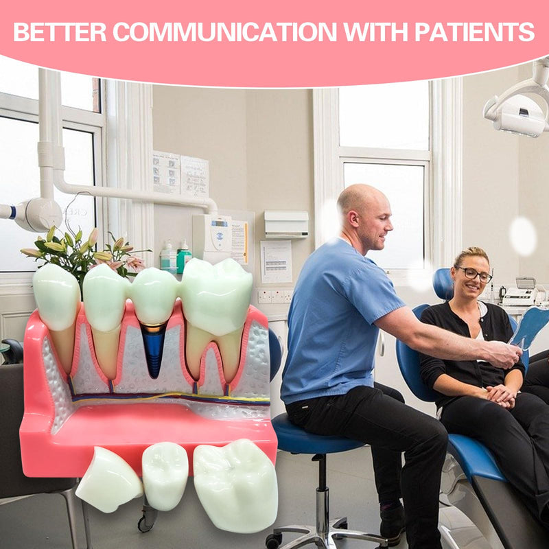 Dental Implant Model 4 Times Implant Teeth Model, Removable Dental Crown Bridge Model, Dental Implant Training Kit for Patient Education 4 teeth