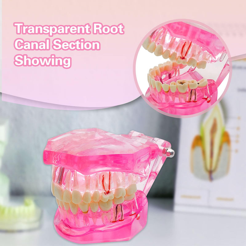 Transparent Disease Teeth Model with Dental Implant Bridge, Dental Teach Crown Bridge Removable Model, Tooth Model for Patient and Dental Student Education. (Red) Red