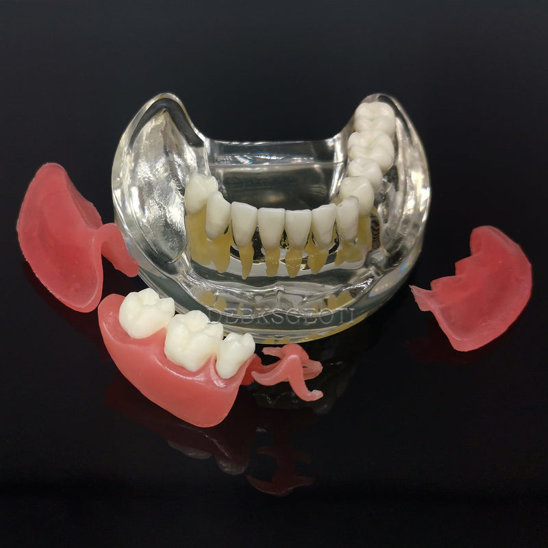 Dental Implant Typodont Restoration Teeth Model M6006 Overdenture 3 Implants Bridge Inferior Lower Treatment Demo for Study Teach