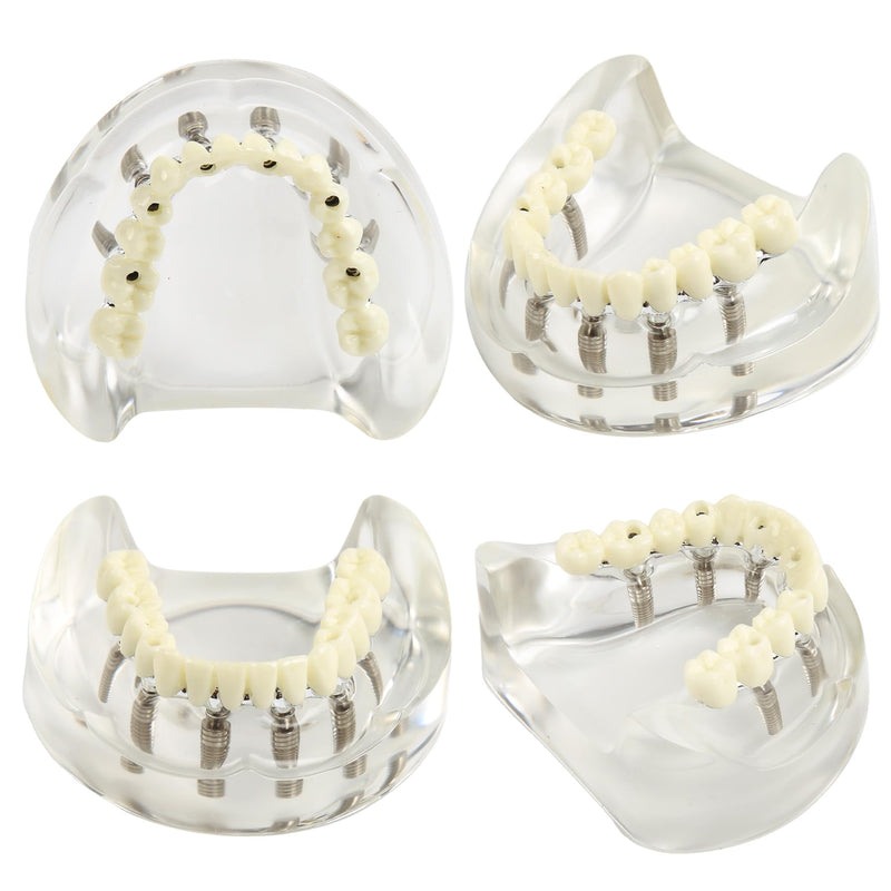 Dental Implant Model Transparent Upper Jaw with 6 Implants Removable Screws | Overdenture Restoration, Dental School Teaching Lab Demo, Patient Education