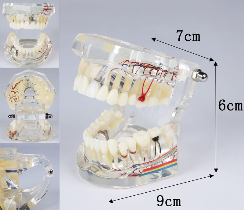 Neural Repair Dental Model Implant Disease Teeth Model Dentist Standard Pathological Removable Teeth Teaching Model for Dentist School Educating Learning