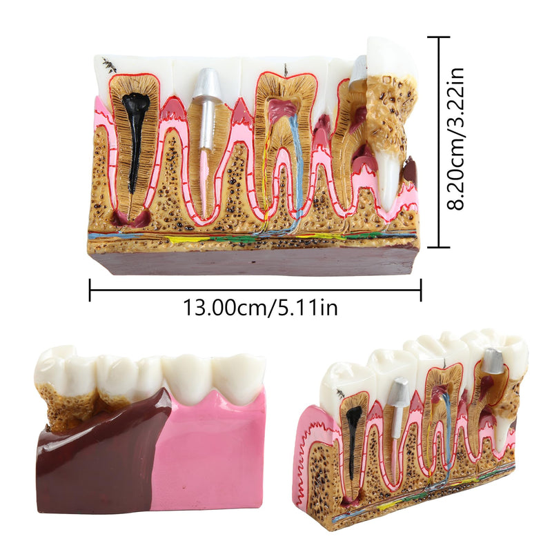 Dental Caries Tooth Anatomy Model Tooth Pathology Models | Caries Evolution Model, Comprehensive Structure Teaching, Oral Study
