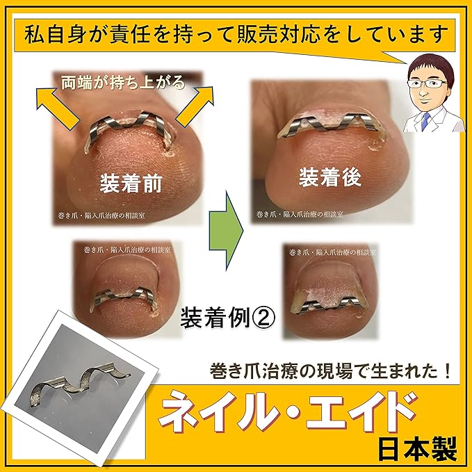 Nail Aid 0.6 inch (16 mm) Winding Nail Correction Self-Winding Wire Clip - NewNest Australia