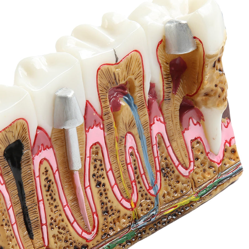 Dental Caries Tooth Anatomy Model Tooth Pathology Models | Caries Evolution Model, Comprehensive Structure Teaching, Oral Study