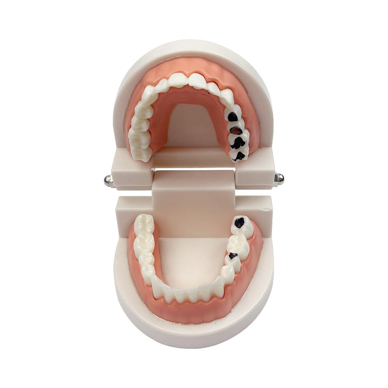 Decay Tooth Model, YOUYA Dental Caries Standard Teeth Teaching Model Study Tool Adult Disease Standard Typodont Demonstration Teeth Model for Kids Oral Care Teaching