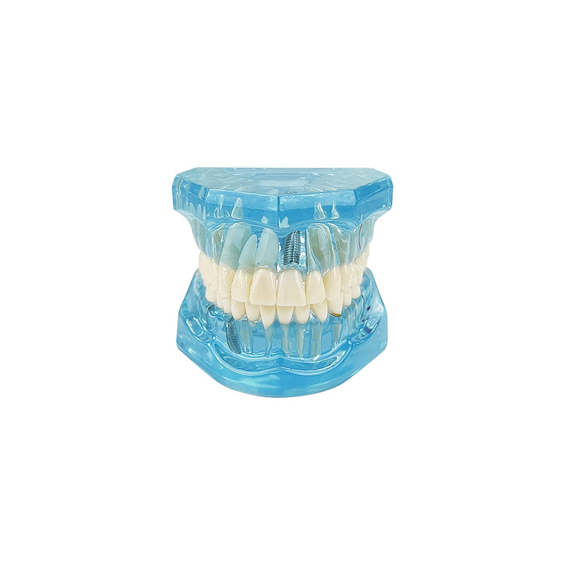 Transparent Disease Teeth Model, YOUYA DENTAL Transparent Dental Implant Teeth Model Dentist Standard Disease Removable Tooth Pathological Teaching Model(Blue)