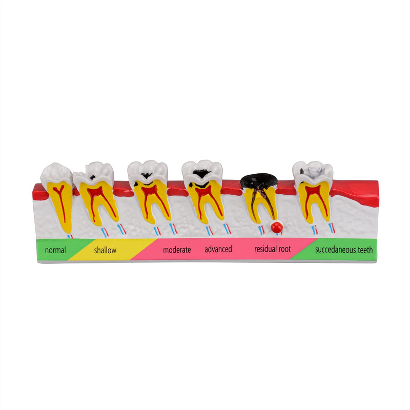 Dental Caries Developing Model, Dental Teeth Model for Dental Tooth Anatomy Study, Doctor-Patient and Oral Care Education Developing Decay Model