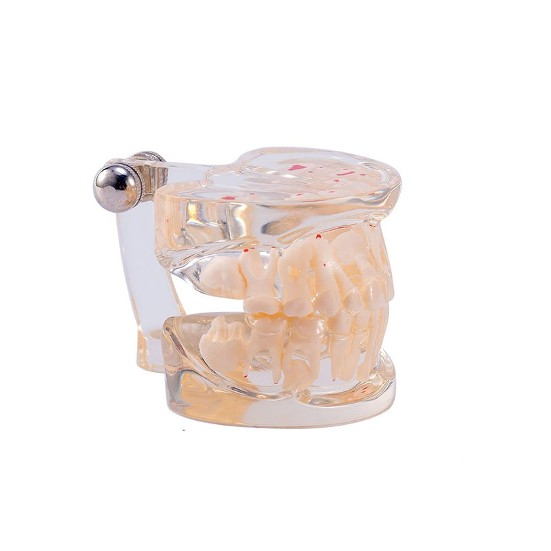 SNAWOP Dental Pathology Model Pediatric Teeth Model Clear Mixed Age Kids Disease Tooth Model
