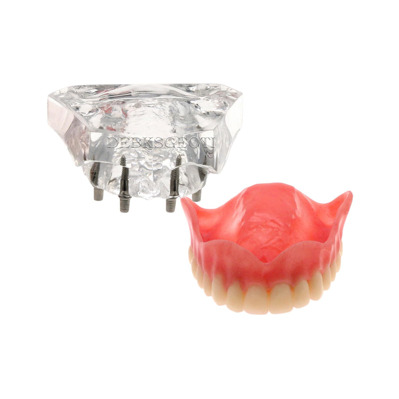 Dental Implant Typodont Restoration Teeth Model M6001 Clear Overdenture 4 Implants Superior Upper Demo for Study Teach