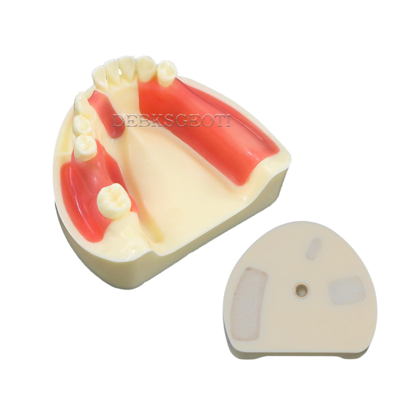 Dental Implant Typodont Practice Teeth Model Lower Jaw Overdenture Soft Gingiva Restoration Demo for Study Teach (M2004)