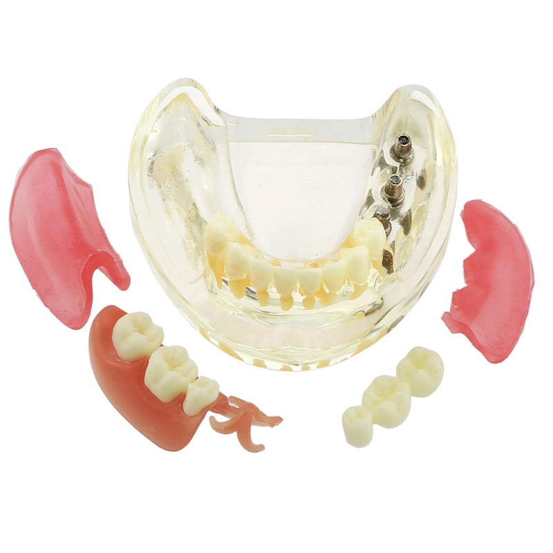 Dental Implant Typodont Restoration Teeth Model M6006 Overdenture 3 Implants Bridge Inferior Lower Treatment Demo for Study Teach