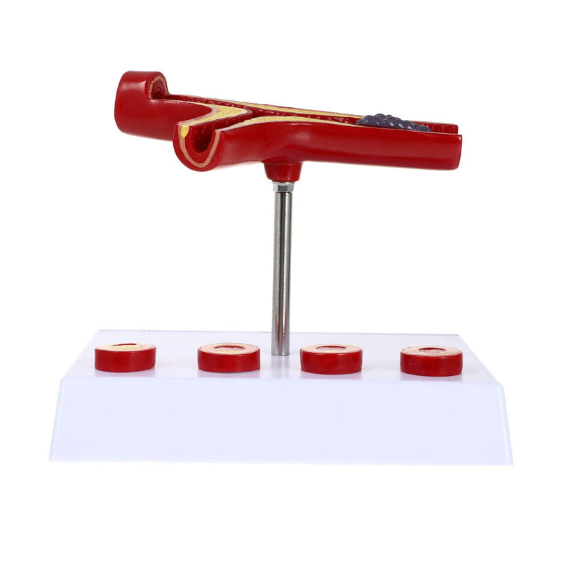 Model Cardiovascular Model Blood Vessel Anatomy with Plaque for Education Teaching Anatomy Display 7.08 X 6.29 X 5.11 in