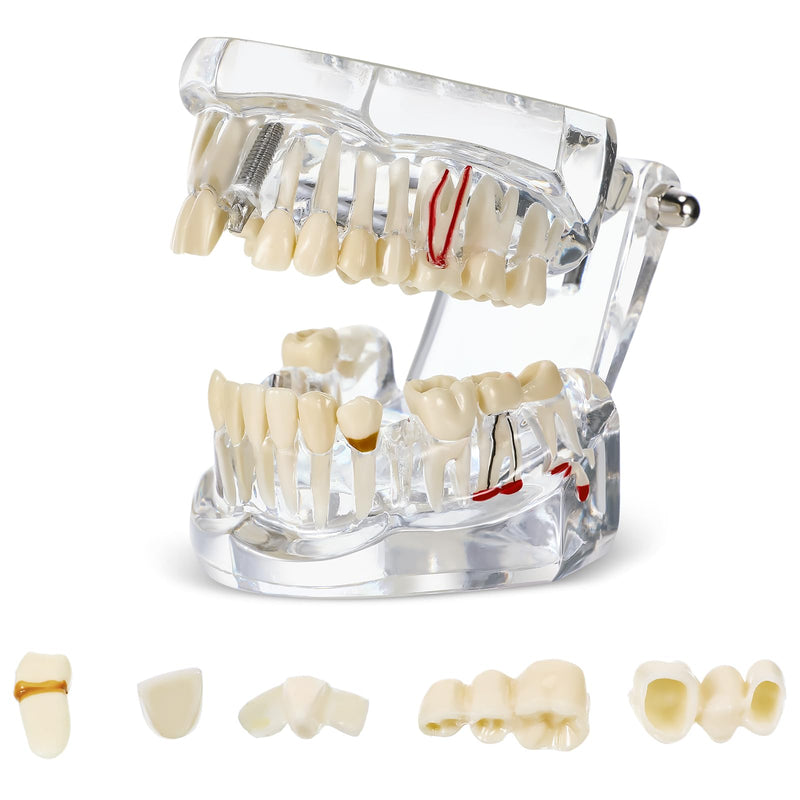 Outus Disease Teeth Model Dental Typodonts Implant Teeth Model with Removable Teeth Dentist Standard Tooth Pathological Demonstration for Christmas Education Dental Supplies (Transparent,1 Pcs) 1 Transparent