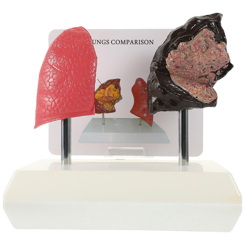 Hemoton Smoking Lung Model and Normal Lung Comparison Pulmonary Anatomy Model for Teaching 7.87X7.08X5.51 Inch Realistic Respiratory Health Education Tool