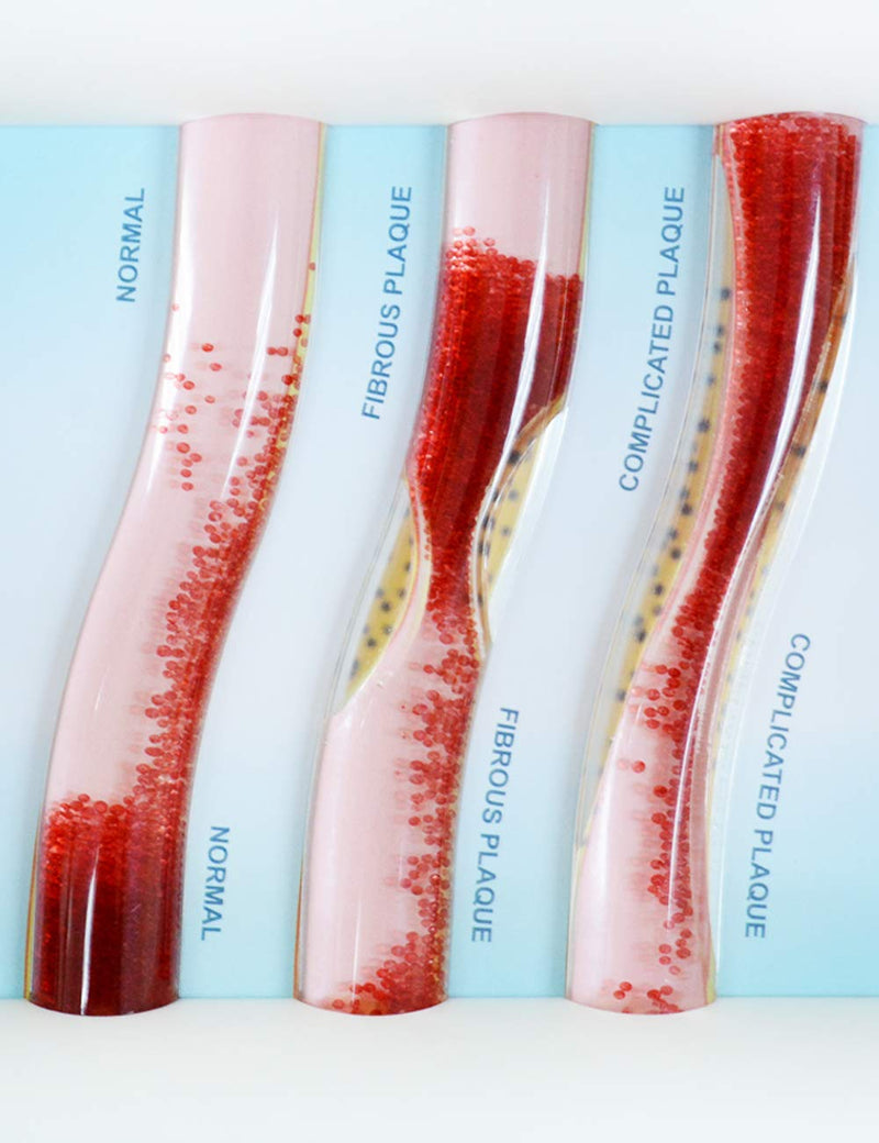 SimCoach Low-Density Lipoprotein LDL Blood Vessel Model for Medical Patient Doctor Teaching