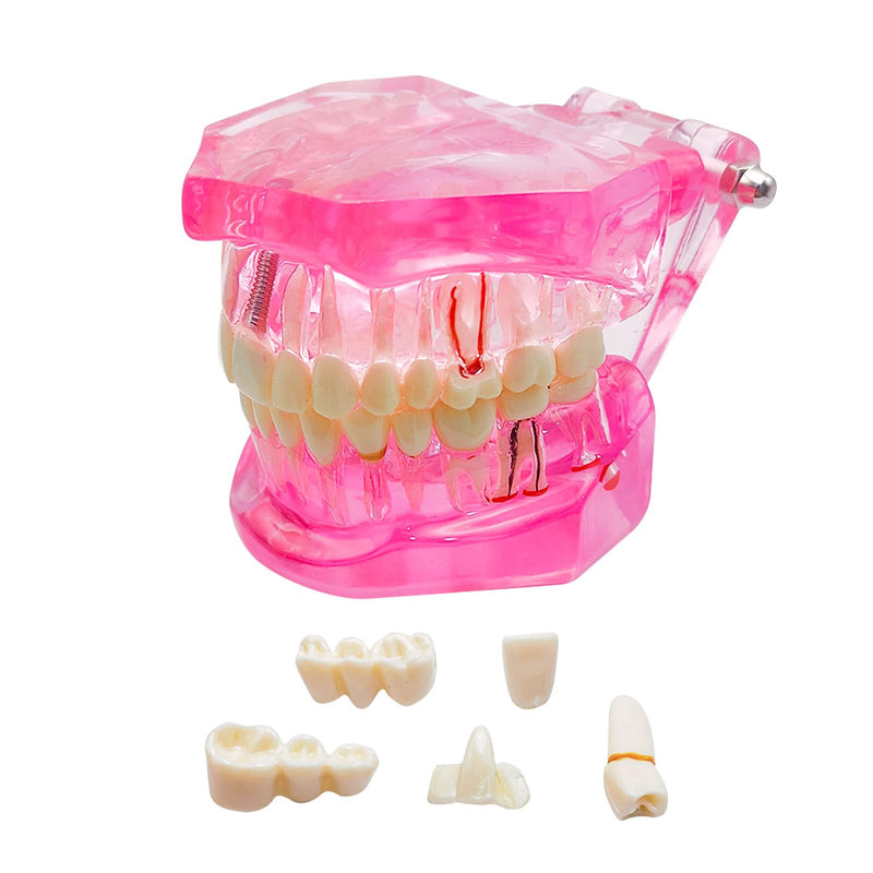 Transparent Disease Teeth Model with Dental Implant Bridge, Dental Teach Crown Bridge Removable Model, Tooth Model for Patient and Dental Student Education. (Red) Red
