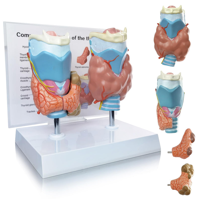 EVOTECH SCIENTIFIC Human Thyroid Pathology Anatomical Model - 4 Parts Life Size Medical Study Education Tool W/Stand and Manual for Demonstrating Goiter, Thyroid Cancer, and Graves’ Disease