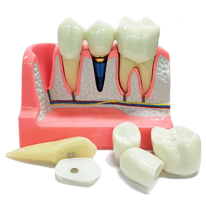 Dental Implant Model 4 Times Implant Teeth Model, Removable Dental Crown Bridge Model, Dental Implant Training Kit for Patient Education 4 teeth