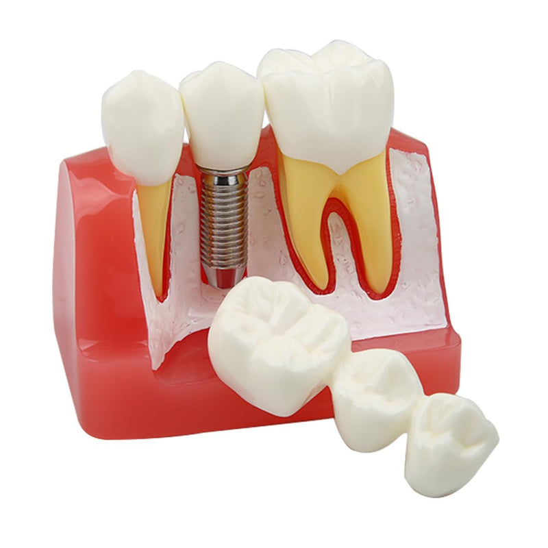 Dental Implant Model Removable Crown Bridge 4 Times Teeth Demonstration Model for Teaching Demonstration,Patient Education and Student Learning B